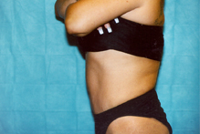ofodile plastic surgery, liposuction