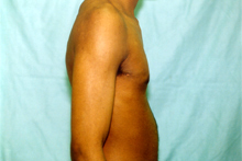 ofodile cosmetic surgery, gynecomastia