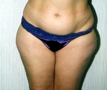 ofodile plastic surgery, suction lipectomy